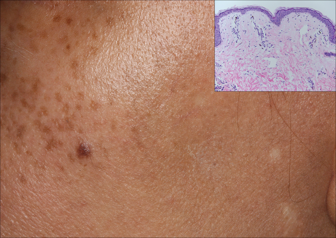 How To Reverse Hyperpigmentation